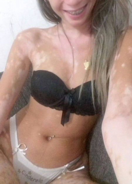 Gostosa com vitiligo pelada caiu na net 13